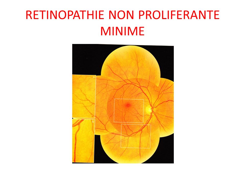 Retinopathie Diabetique Ppt Video Online T L Charger